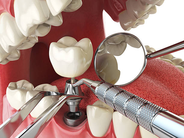 Best Same-Day Emergency Dental Services in Kapn, LA